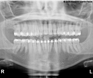 Marie-Hélène Cyr - Radiographie panoramique avant la chirurgie orthognatique (5 mars 2008)